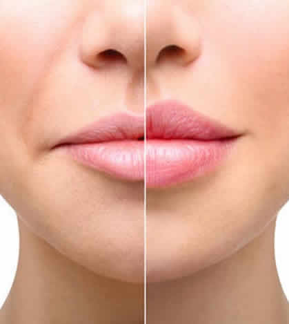 dudak büyütme öncesi ve sonrası
